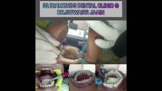 Chronic Periodontitis and Teeth Splinting [upl. by Pisarik]