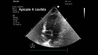 Cœur pulmonaire aigu [upl. by Watanabe169]