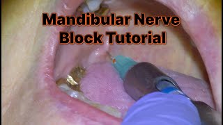 1 How to Administer a Mandibular Nerve Block [upl. by Roid]