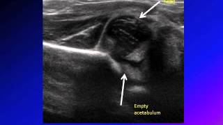 DDH developmental dysplasia of hip congenital hip dislocation CHD [upl. by Anairol]