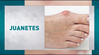 Juanetes o Hallux Valgus Síntomas causas y tratamiento [upl. by Padraig]