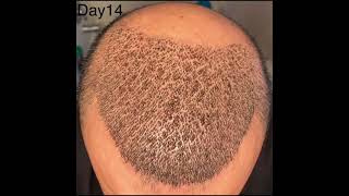 Hair transplant  20 day’s 4200 graft Dr Serkan Aygın Clinic [upl. by Baker764]