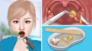 ASMR Tonsil stone removal  Treatment the cause of bad breath  편도선 석재 제거  구취의 원인 [upl. by Inan]