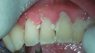 Plaque removed  Dental calculus  Long overdue plaque removal [upl. by Sabas]