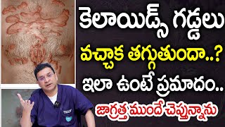 Dr Movva Srinivas  What is the best treatment for Keloid in young people  Dr MOvva [upl. by Zoe]