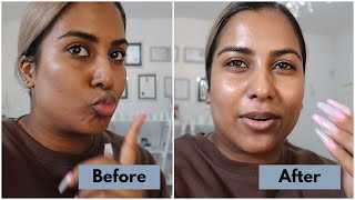 Skin Vlogs with Dr Saffia Jacobs  Melanostop Peel [upl. by Ul234]