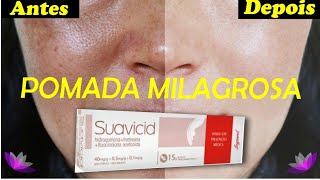 SUAVICID TUDO SOBRE A POMADA MILAGROSA PARA MANCHAS e MELASMA  SUAVICID ANTES E DEPOIS [upl. by Krenek672]