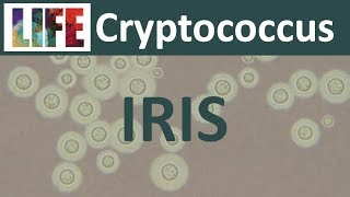 Cryptococcal IRIS [upl. by Drud]