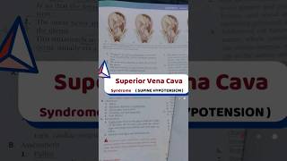 SUPINE Hypotension ✂️  Vena cava Syndrome  aiims norcet nclexrn saunders [upl. by Ylloj755]