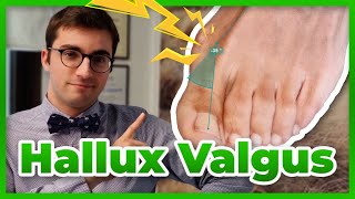 Hallux valgus  diagnostic prévention et traitement [upl. by Nelram882]