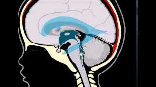 Terceiroventriculostomia ou neurocirurgia endoscópica [upl. by Ramhaj411]