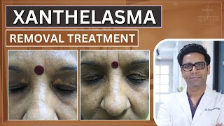 Xanthelasma Removal Treatment  Xanthelasma Removal  Xanthelasma Removal Laser  Xanthelasma [upl. by Ennaeirrac]