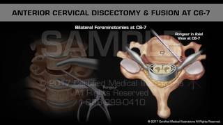 Anterior Cervical Discectomy amp Fusion at C67 [upl. by Aba]