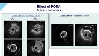 Optimizing PCI Using FFR amp HD IVUS Part 4  Role of IVUS in Guiding Calcium Modification Strategies [upl. by Flinn]