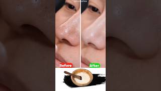 Best home remedy to remove Blackheads amp Whiteheads  How to get rid of pimple on your chin [upl. by Ymmik]