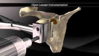 Open Latarjet Instrumentation [upl. by Ahsehyt]