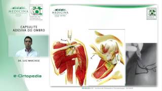 Capsulite Adesiva do Ombro  Dr Luiz Marchese [upl. by Kelwunn213]