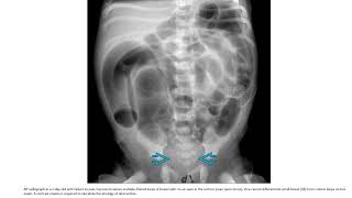 Hirschsprung Disease Imaging [upl. by Enitsugua915]