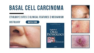 Basal cell carcinoma  Epithelial Pathology  Histology  Etiology  Oral Pathology [upl. by Harlen]