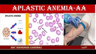 Lecture 161 Aplastic Anemia  AP [upl. by Kavanaugh]