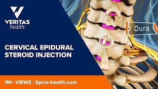 Cervical Epidural Steroid Injection [upl. by Leisha]