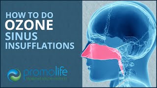 How to do an Ozone Sinus Insufflation [upl. by Rurik76]