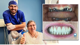 PROTEZA NA 4 IMPLANTATA  Proteza na prečku  Dental Centar 4Smile [upl. by Nitsu195]