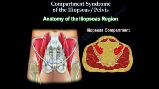 Iliopsoas Pelvic Compartment Syndrome Everything You Need To Know Dr Nabil Ebraheim [upl. by Nnalatsyrc]