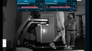 Quadriceps Avoidance Walking Gait Analysis [upl. by Noguchi519]