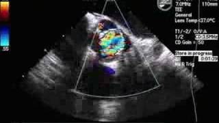 Quadleaflet Aortic Valve [upl. by Cheke]