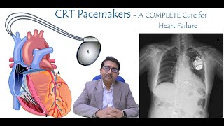 CRT P  CRT D Pacemaker  Complete Cure for Heart Failure [upl. by Mcclain875]