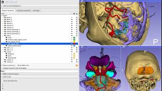 Posterior cranial fossa tumors Neurosurgical planning [upl. by Nerak234]