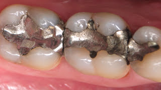 Are there any alternatives for post crowns in root filled teeth  Dr Aniruddha KB [upl. by Amre]