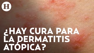 Dermatitis atópica Qué la causa cuáles son los síntomas y qué tratamientos hay  Médico H [upl. by Bilac]