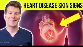 12 SKIN and NAIL signs of HEART DISEASE [upl. by Sansen]