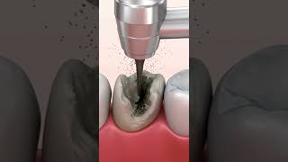 Tooth caries removal dentalcare dentalhygiene caries [upl. by Maude]