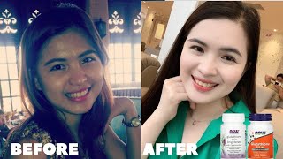 GLUTATHIONE BEFORE AND AFTER How to whiten skin [upl. by Cartie]