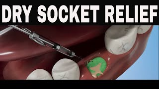 The Ultimate Guide to Dry Socket Management What You Need to Know drysocket [upl. by Llednahc617]