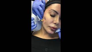 Bellafill Injections for Acne Scarring with Dr Jason Emer MD  Live  Part 1 of 3 [upl. by Janine]