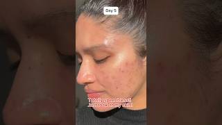 Dark spot serum for acne skin acnes skincare acneskin kbeauty koreanskincare acnescars [upl. by Eseerahs]