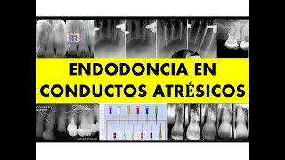 quotENDODONCIA EN CONDUCTOS ATRÉSICOSquot [upl. by Vitek]