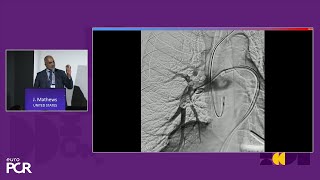 Advancing percutaneous treatment of pulmonary embolism with computerassisted vacuum thrombectomy [upl. by Lankton11]