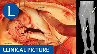 Antiphospholipid syndrome following Q fever [upl. by Sidonius]