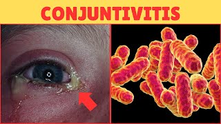 Alerta🚨 Conjuntivitis Bacteriana y Viral sintomas y tratamiento [upl. by Okuy341]