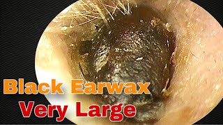 BIGGEST Earwax Difficult Removal EP 12  Doctor Anh [upl. by Rann161]