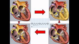 Taquicardias supraventriculareswmv [upl. by Hayimas]