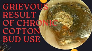 GRIEVOUS Result Of Chronic Cotton Bud Use Very Satisfying Earwax Removal [upl. by Julietta445]