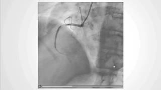 Decoding the NoReflow Phenomenon Coronary Microcirculations Role [upl. by Ohcirej611]