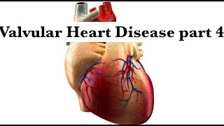 Valvular Heart Disease part 4Aortic amp pulmonary Stenosis and regurge by ASM Minds Team [upl. by Jerrol]