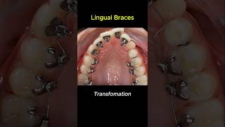 Lingual braces transformation braces orthodontist bracket [upl. by Akirdnwahs306]